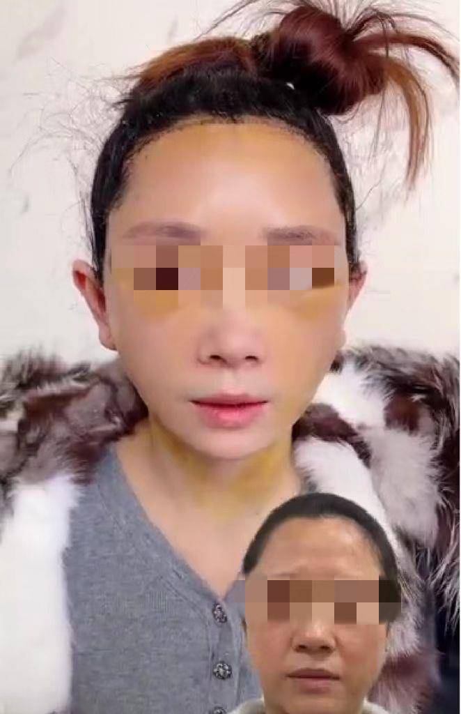 苹果版袋袋付
:47岁女士做过拉皮后，觉得自己看起来像20多岁