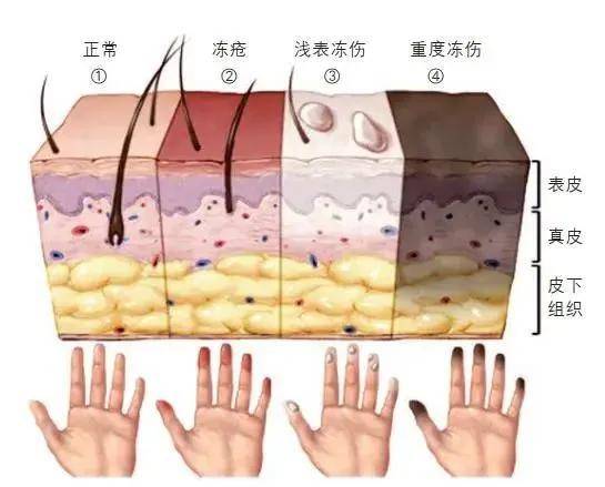 生姜去皮肤推荐苹果版:冻疮的“前世今生”-第3张图片-太平洋在线下载